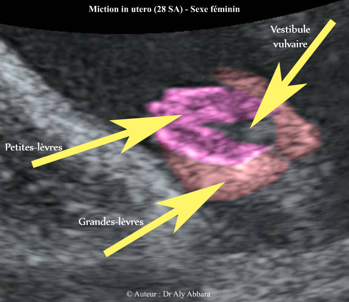 Vulve : 28 SA ; éléments anatomiques